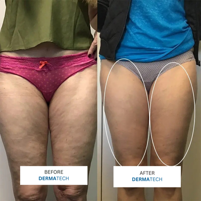 DERMATECH 4 in 1 Sculping Device